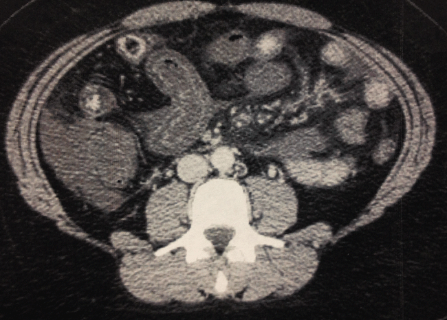 Figure 2. Computed tomography imaging of the abdomen shows thickening of the bowel indicating ischemia, with stranding and fluid in the mesentery.