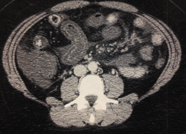 Figure 2 Figure 2. Computed tomography imaging of the abdomen shows thickening of the bowel indicating ischemia, with stranding and fluid in the mesentery.