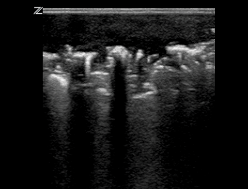 Figure 1. Subcutaneous air (Fournier's gangrene) seen as bright foci with posterior scattered shadowing.