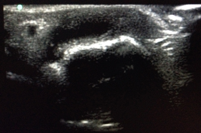 Image 1. Short axis view of MCP joint with effusion present.