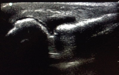 Image 2. Long axis view of MCP joint with effusion present.