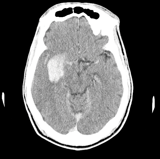 Image 2. Repeat CT showing intracerebral hemorrhage  €“ the most feared complication of tPA