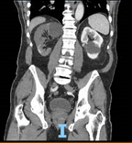 10 Common Causes of Blood in Urine for Men (Hematuria) - Homage Malaysia