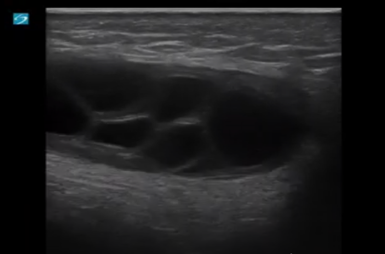 Pediatric Inguinal Hernia with Mass - Image 1.png