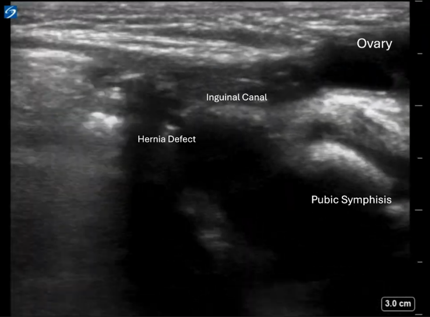 Pediatric Inguinal Hernia with Mass - Image 2 Sagittal View.png