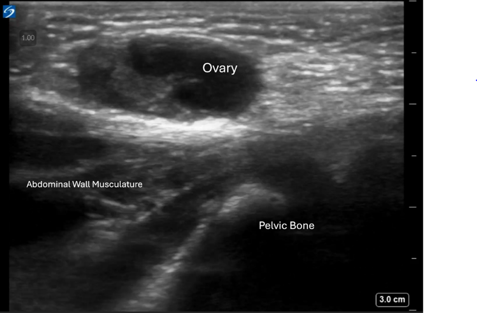 Pediatric Inguinal Hernia with Mass - Image 3 Transverse View Ovary within Hernia.png