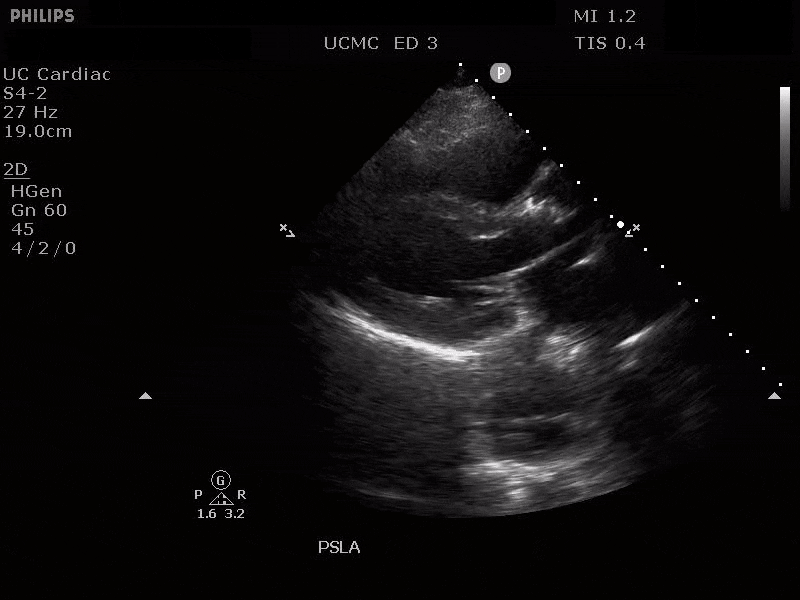 Aortic Dissection 3.gif