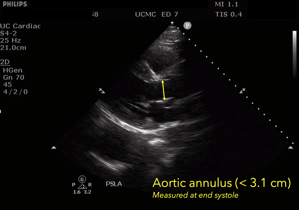 Aortic Dissection 5.png