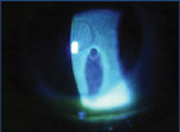 Image 3. Positive Seidel test. Fluorescein staining of the intraocular contents secondary to corneal perforation.