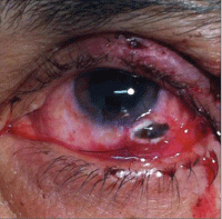 Image 4.  Globe rupture. Scleral defect (left) and close-up of the scleral rupture as seen by biomicroscopy (right).