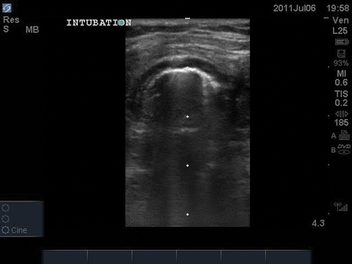 Figure 2. Image of normal airway anatomy, showing normal trachea with the hypoechoic tracheal ring and hyperechoic air-mucosal interface.