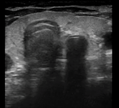 Figure 4. Image of esophageal intubation. Note the presence of two hyperechoic air-mucosal interfaces indicating the presence of the endotracheal tube within the esophagus.