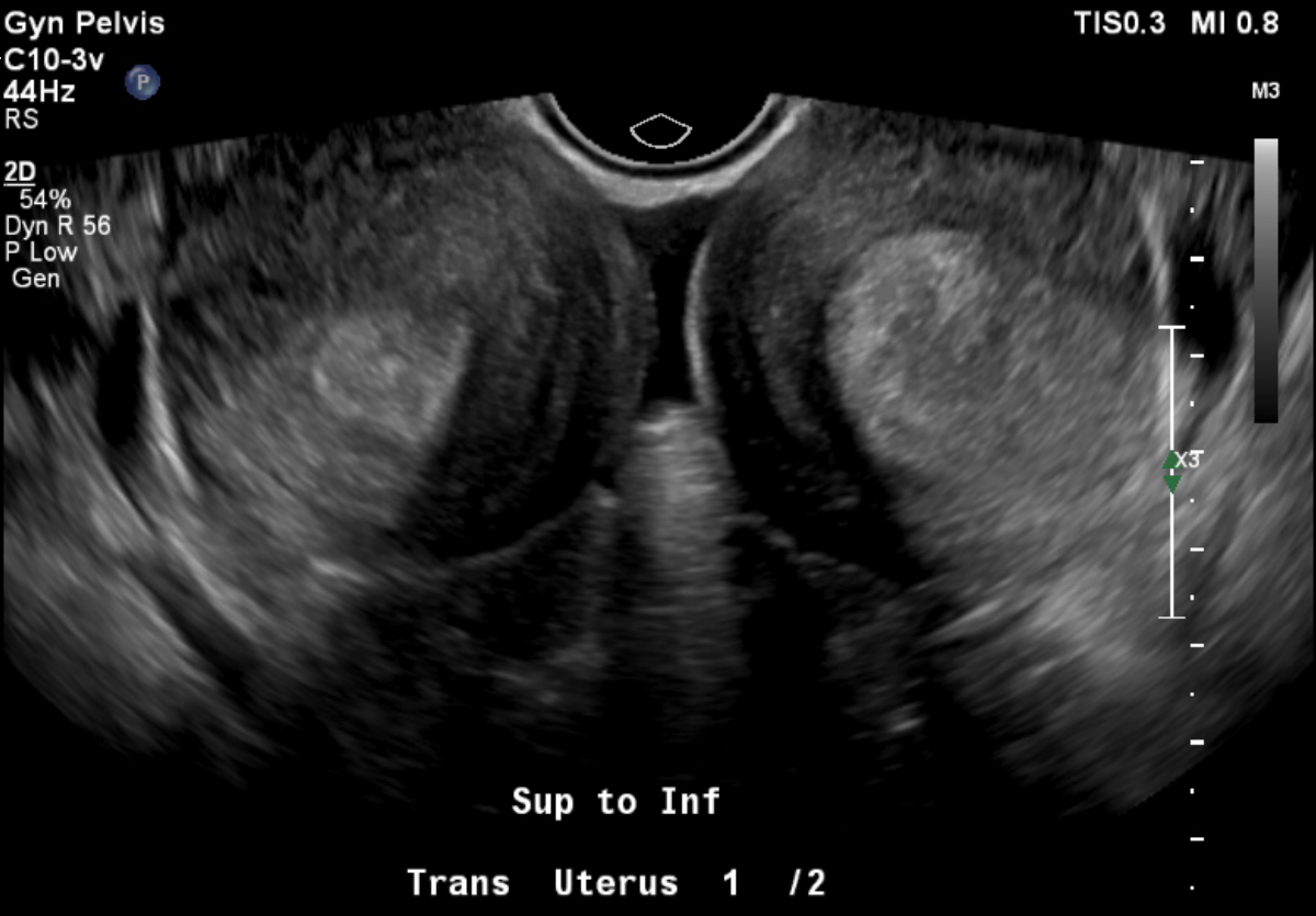 Uterine Didelphys - Fig 1 trans-uterus.png