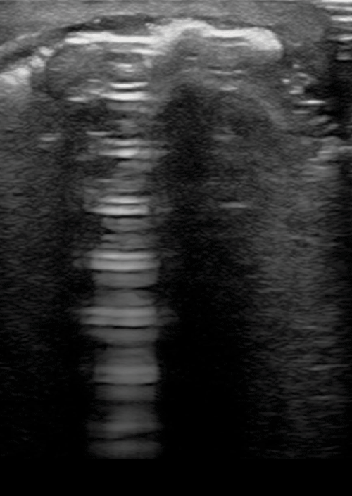 Image 1. Reverberation artifact originating from the patient's upper extremity soft tissue. 