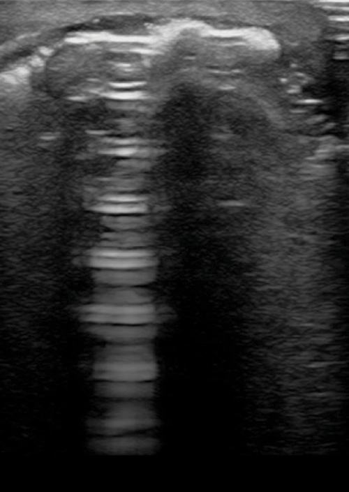 A common misunderstanding in lung ultrasound: the comet tail artefact