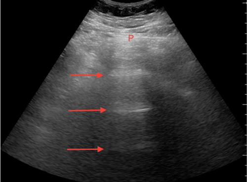 Image 2. Ultrasound of the abdomen demonstrating reverberation artifact originating from the abdominal peritoneum.