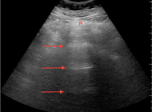 An Upgrade to 3-D Mammography Necessitates Re-evaluation of Skin Markers |  Imaging Technology News