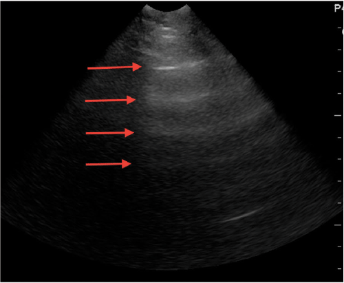 Image 3. Ultrasound of the abdomen demonstrating reverberation artifact originating from the abdominal peritoneum.