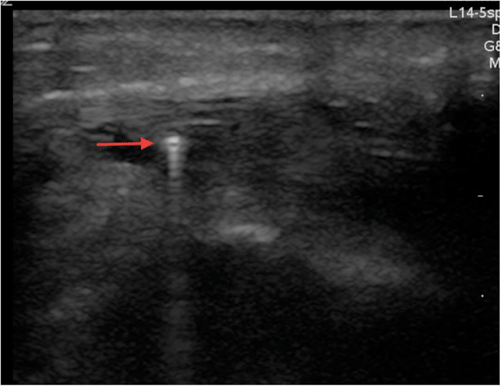 Image 4. A soft tissue ultrasound demonstrating the foreign body with associated reverberation, ring-down artifact.