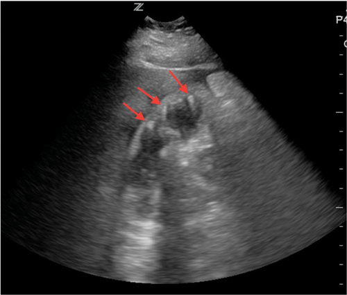 Image 5. Gallbladder with several reverberation artifacts originating within the gallbladder wall.