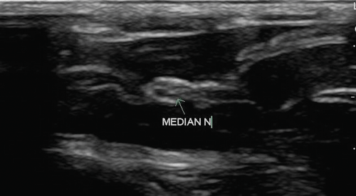 Image 1. Median nerve on ultrasound