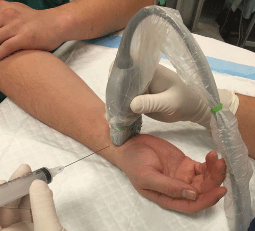 Three-in-One: The Forearm Nerve Block EMRA