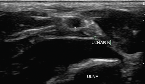 Image 3. Ulnar nerve on ultrasound; a = ulnar artery