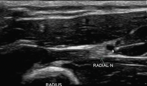 Image 5. Radial nerve on ultrasound (arrow); a = radial artery