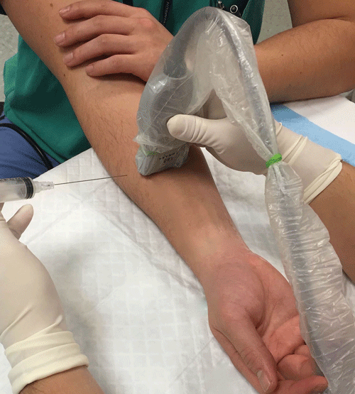 Image 6. Approach to ultrasound-guided radial nerve block