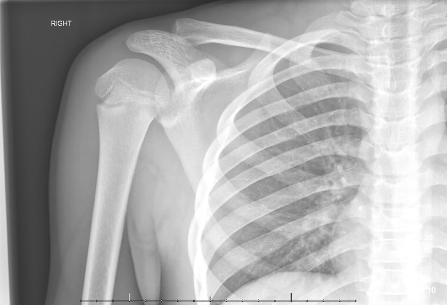 Recanting Impressions Posterior Sternoclavicular Joint Dislocation EMRA