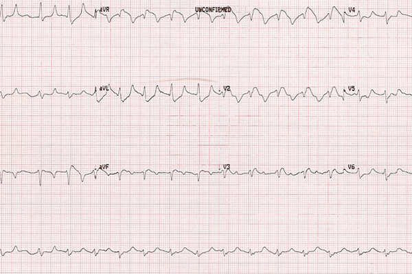 hyperkalemia ecg findings wikimedia hyperkalemia ecg findings wikimedia