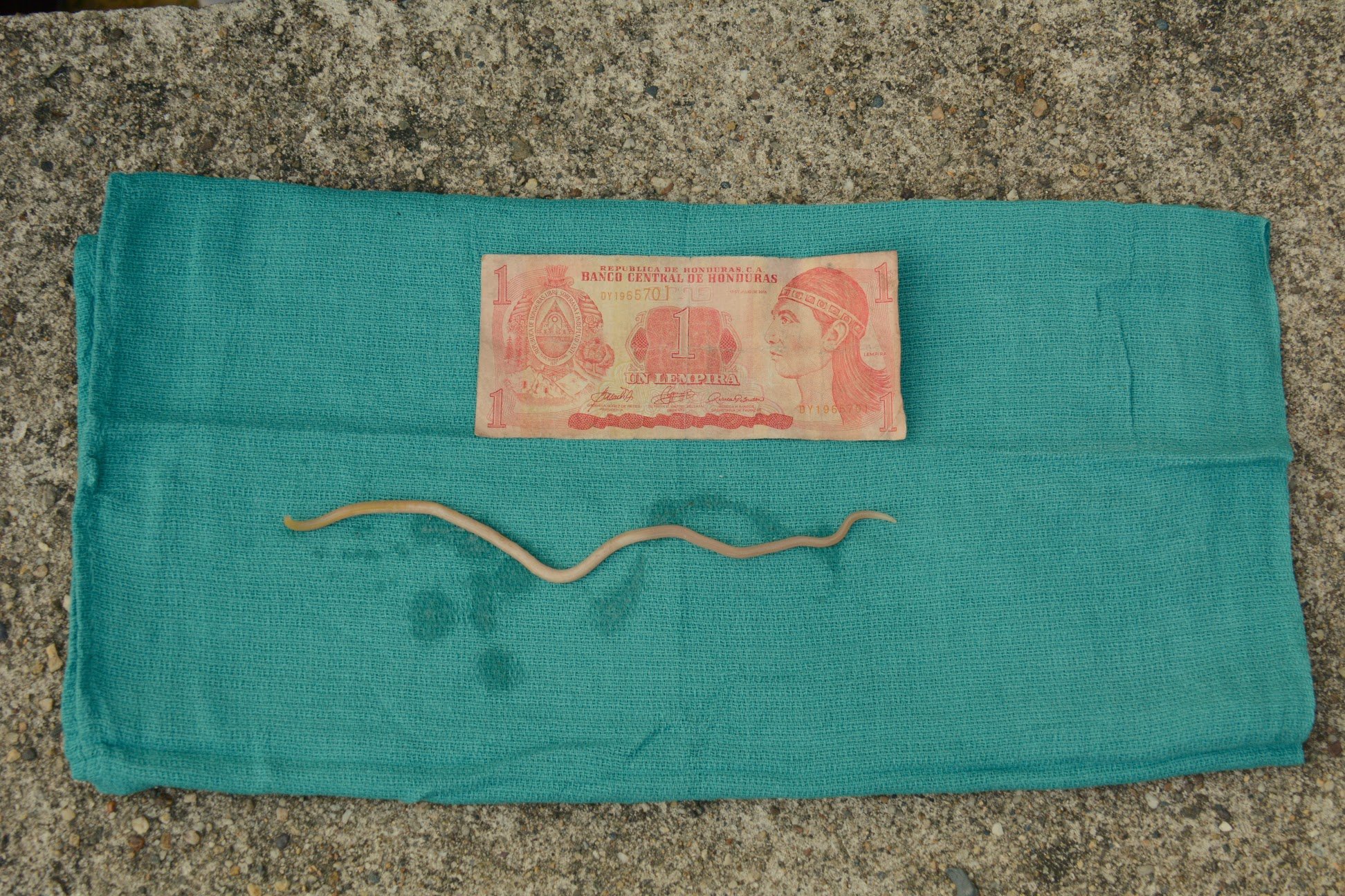 FIGURE 2. A roundworm retrieved from the emesis of a female with a SBO secondary to ascariasis infection appears next to a Honduran lempira, roughly the same size as a dollar bill.