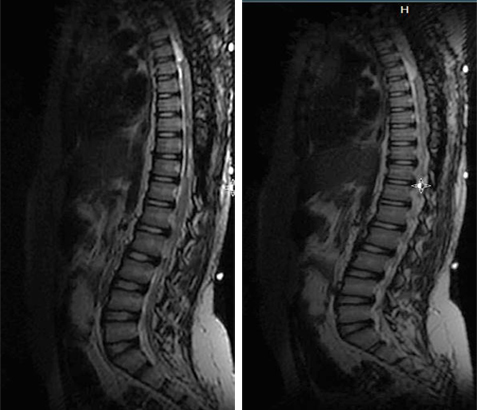 MRI of the spine shows diffuse intradural enhancement, nodular lesions at T2-T3, and abnormal signal at multiple levels, suggesting craniospinal melanomatosis with neurocutaneous melanosis.