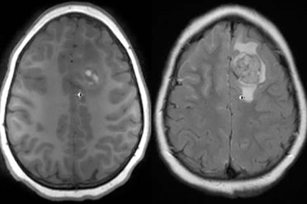 MRI of the brain shows nodular area with hyperintense (T1 signal) in the left frontal lobe with surrounding edema consistent with metastatic lesion and significant diffuse leptomeningeal enhancement.