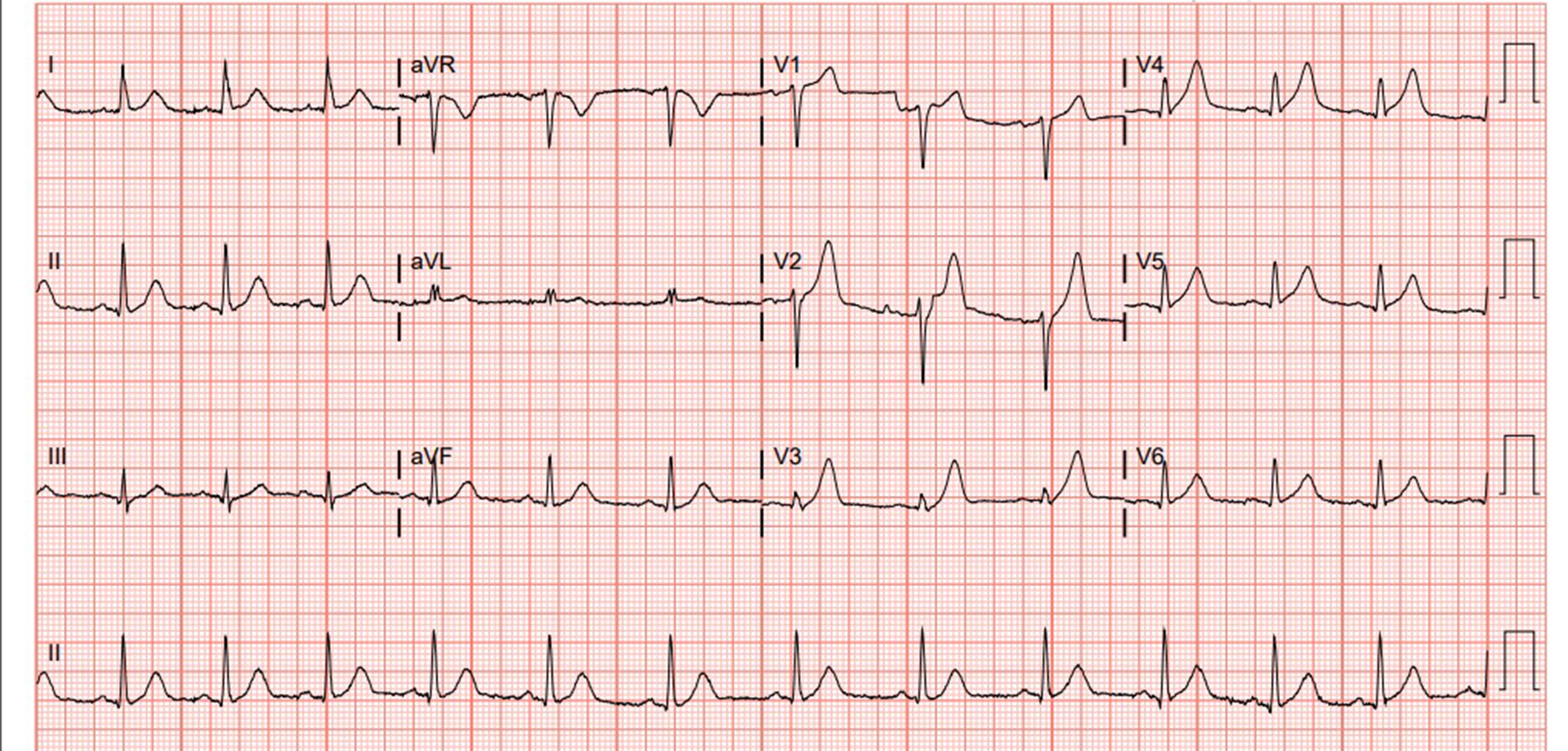 what is the meaning of unconfirmed report in ecg