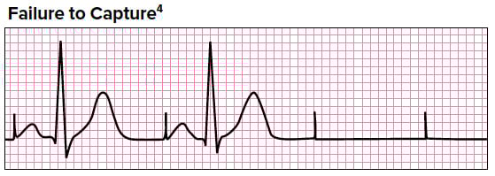 Pacemaker Basics For The Emergency Physician Emra Pacemaker Basics For The Emergency Physician Emra