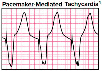 Pacemaker-Mediated Tachycardia
