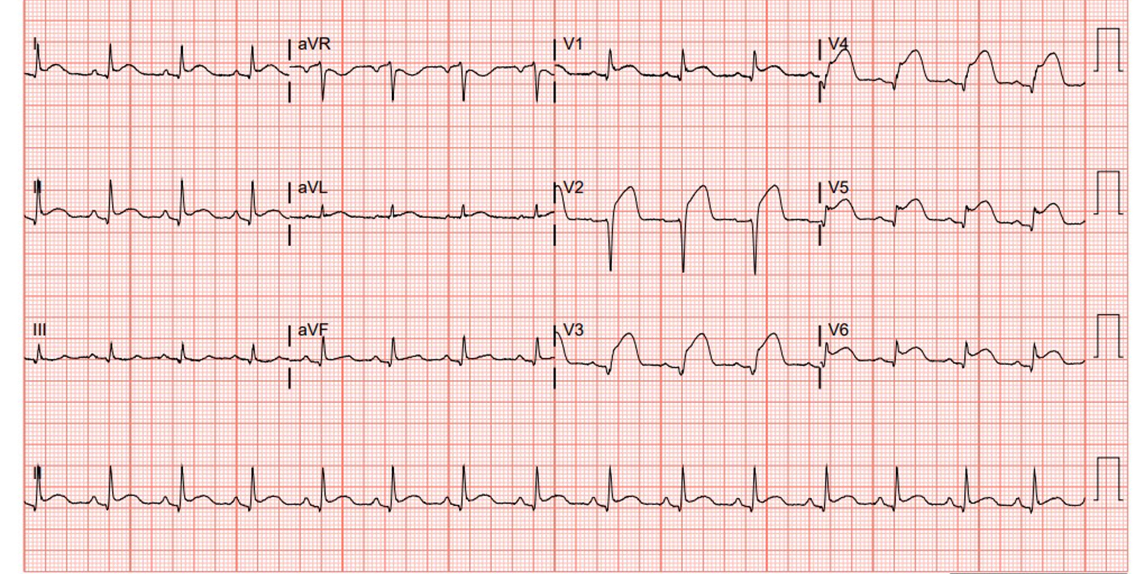 Ecg Diagnosis Acute Myocardial Infarction In A Ventricular Paced | Hot ...