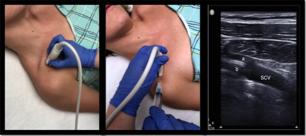 Ultrasound-Guided Subclavian Vein Cannulation: The Vessel to Remember EMRA