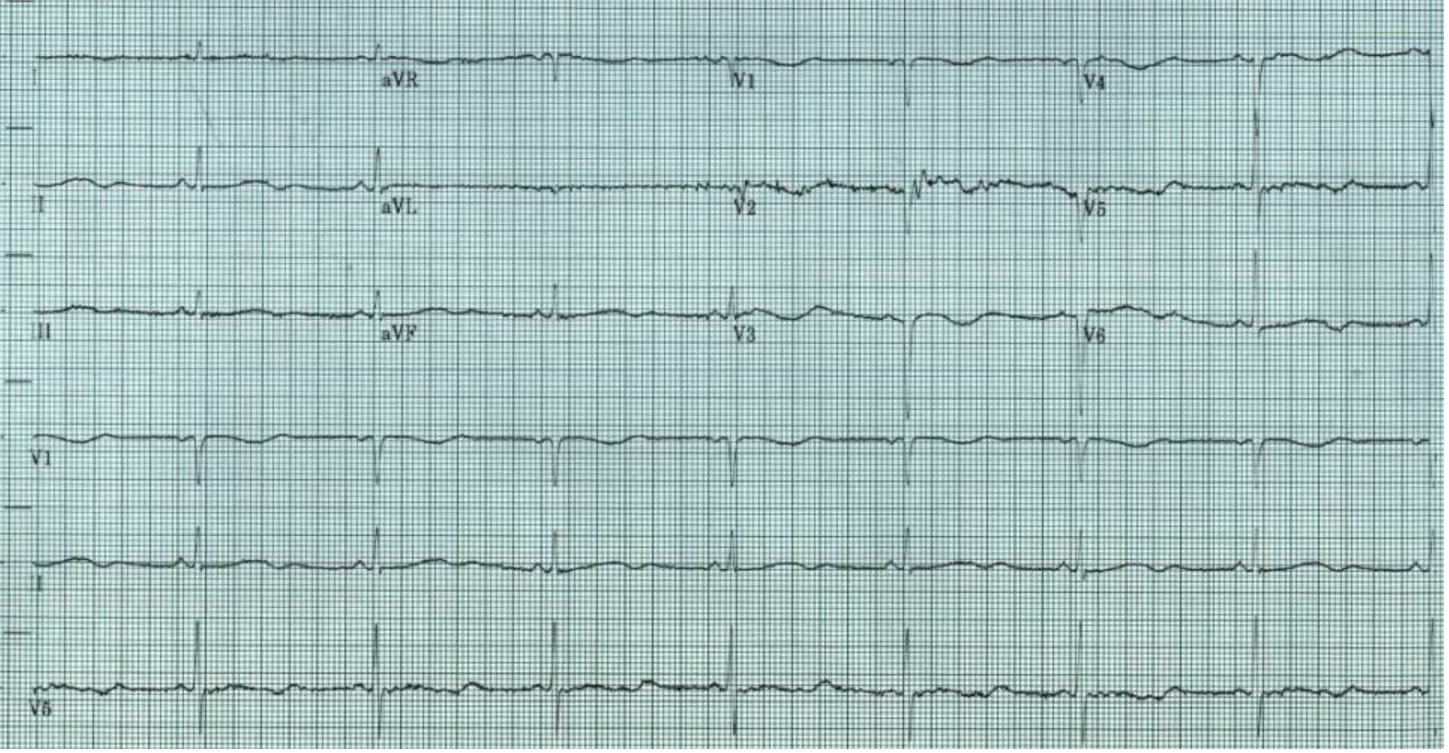 gabapentin sinus bradycardia