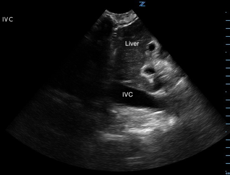 An Atypical Presentation Cardiac Tamponade and the Value of Pointof