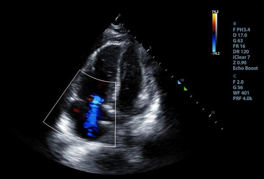 Figure 4. An A4 view with color doppler