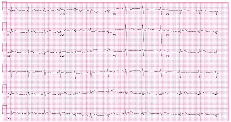 Figure 1 Initial EKG