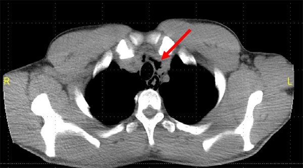 Pneumomediastinum Secondary To Medication Induced Esophageal Microperforation Emra