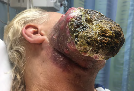 DENIAL OF DEATH : The Phenomenon of Tumor Neglect EMRA