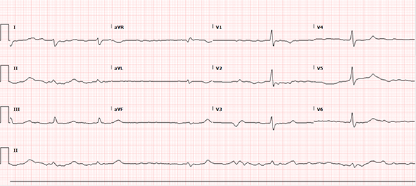 47-5 Antidysrhythmic EKG.png