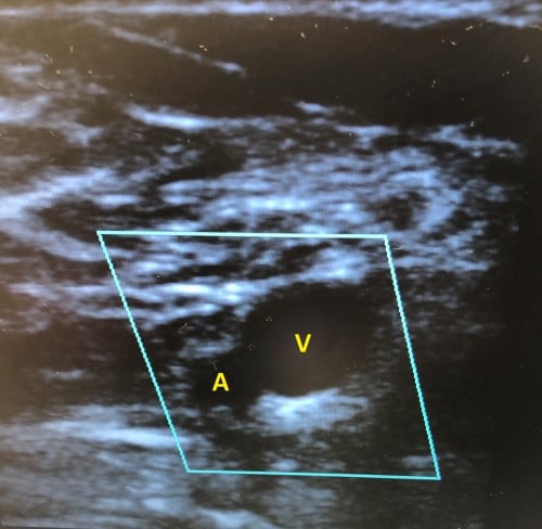 47-6 Popliteal Artery - Figure 1.jpg