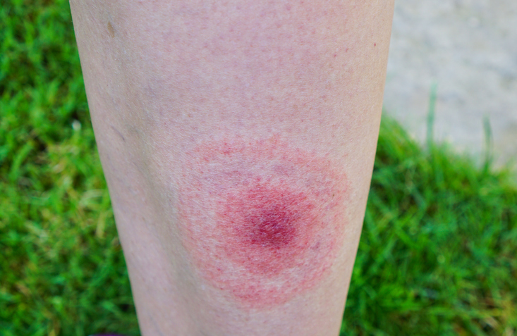 Pericardial Effusion: A Rare Case of a Potentially Dangerous Manifestation of Lyme Disease