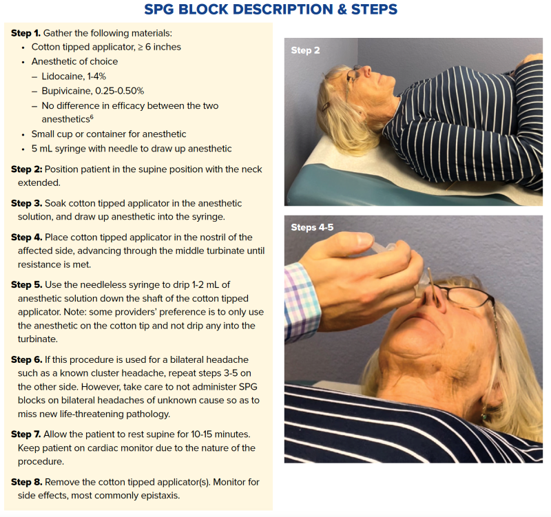 Oficiales Increíble Admitir sphenopalatine ganglion block technique