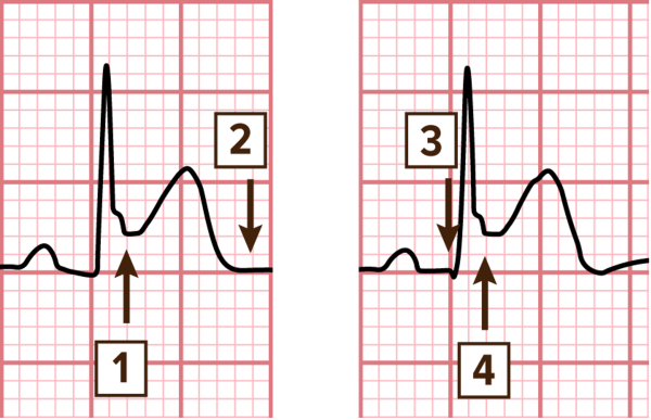 48-5 ECG Challenge - answer fig 2-3.png